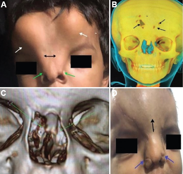 (A) Para-median subcutaneous forehead bulges (white arrows), hyper-telorism and broad nasal bridge (black arrows) and bilateral Tessier Cleft 1/13 (green arrows). (B) Multiple small bony gaps in the frontal bone with no evidence of meningocoele or encephalocoele (black arrows). (C) Absent nasal process of the frontal bone on both sides suggestive of bilateral Tessier Cleft 1/13 (green arrow). (D) Rotation of alar flap to meet the columellar tip was done bilaterally (blue arrows). Pedicled dermofat graft was raised from bilateral forehead bulges and sutured in the midline (black arrows).